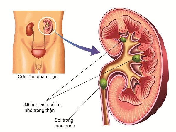 trieu-chung-soi-nieu-quan-va-cach-dieu-tri