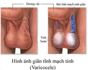 benh-gian-tinh-mach-thung-tinh-co-nguy-hiem-khong